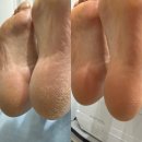 안산 초지동문제성발 &lt;여나네일&gt; 발각질 케어 후기