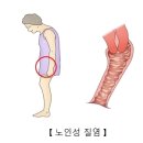 노인성 질염(Senile (atrophic) vaginitis) 여성 질환이란? 이미지