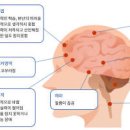 음주 술 취했을때 필름 끊김, 블랙아웃 현상 원인 + 아세트알데히드 이미지