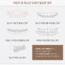 누가광명의원 | 광명치아교정 투명교정? 가장 많이 묻는 질문 3가지 답변 (FAQ)