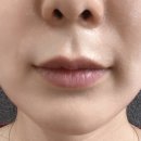 입술필러 3주차 동성로 성형외과 필러맛집 후기