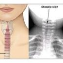 급성 폐쇄성 후두염[acute laryngotracheobronchitis] 이미지