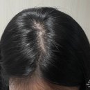 코리아병원 | [볼빅]병원샴푸 브랜드 볼빅 미토 코리아 탈모샴푸 사용후기