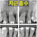 강서바른이치과교정과치과의원 네이버블로그