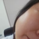 요녀석 화곡점 | 화곡역 피부과 편평사마귀 얼굴점제거 레이저 효과 일주일 찐 후기