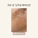 광교 퍼스트 피부과 후기, 30대 여성 난치성 베커모반 치료