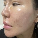 센텀6로 | 부산해운대센텀피부과 여드름,모공흉터자국치료 포텐자+새살침 후기