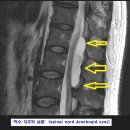 ■ 지주막 낭종(arachnoid cyst) 원인. 증상. 치료 이미지