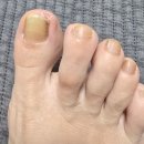 5197 | 아인병원 피부과 발관리센터 발톱무좀 치료후기 (+임산부 진료비 할인,실비)