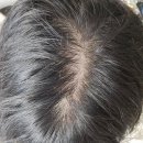 사당두피 SMP 후기 : 라이모에서 가르마 숱보강하고 새 정수리 됐어요 (헤어라인쉐딩 이제 안녕...)