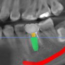 애플치과기공소 이미지