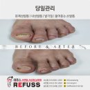 레푸스 사상점 | 부산 사상 발톱 무좀 관리 레푸스 사상점, 스켈링 관리 후기 / 두꺼운 발톱 탈출하고 싶어요!