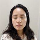 내돈내산 코실리프팅 레이디코 후기 (통증, 붓기 등)