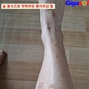 먹지 말아야 할 음식 먹은 결과~콩팥이 뚫어져 안심 이미지