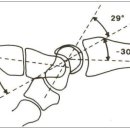 손목 불안정(wrist instability) 이미지