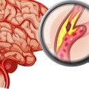 이 뽑다가 구토하고 쓰러져...뇌출혈인 줄 알았는데 '이 병'? 이미지