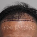 뉴헤어부산에서 모발이식 받고 3개월 만에 5살 젊어진 후기