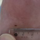 대구세브란스피부과의원 | 🏥 대구 이석종 피부과 의원 진료 후기 2