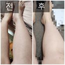 강남레이저제모 젠틀맥스프로플러스 여성종아리제모 7회차 후기 및 가격