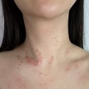 평송의원 | 평택 쥐젖 제거, 평택 편평사마귀 제거, 평송의원, 쥐젖 제거 후 연고 추천