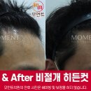 모수테라피