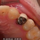 크라운얼음 | 어금니 크라운 깨짐 원인과 PFM 크라운 재신경치료 후기