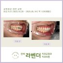 연세라벤더 교정치과 &#34;6월 성인 교정&#34; 후기