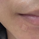 더마인피부과의원 | [문정] 더마인 피부과 여드름 압출 + 튀어나온 점 뺀 후기 + 가격/통증 솔직리뷰