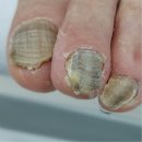 동춘동 홈프러스 | 인천 연수구 송도 동춘동 발톱무좀 한번으로도 효과좋은 곳 에이풋케어 내성발톱 발톱무좀 발각질 문제성발