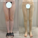청담슬림의원 | 청담슬림의원 허벅지 지방흡입 직후 뼈벅지 가능, 종아리 지방흡입 후기