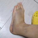 다리편한외과의원 | [정형외과] 수유다나은정형외과 #발목인대파열치료