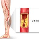 말초혈관 질환이란? 이미지