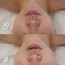 미모종결 이미지