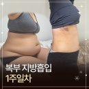 다음 | 복부지방흡입후기 1주일차 지흡 다음날 출근 가능할까요?