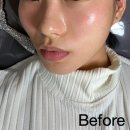 매일온한의원 | 가양 한의원 편평사마귀 거우침 후기 효과 전후 사진 비용