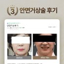 빌리프성형외과 네이버블로그