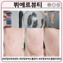 세븐일레븐 의정부센트럴타워점 | 의정부 피부관리 잘하는 곳 | 여드름 흉터관리 화이트 스피큘 뷔에르뷰티 재방문 후기