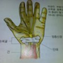 손목굴증후군(수근관 증후군) 이미지