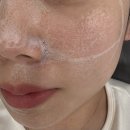 멍꿀잠 | [얼굴형관리] 압구정역피부과 인모드 얼굴전체 일주일 경과 기록 후기 / 멍, 통증