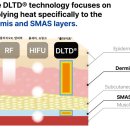 오체안피부과의원 | 과천피부과 올타이트 (Alltite) 리프팅 후기, 부작용, 가격은?