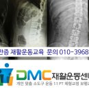 척추측만증 환자 scoliosis 재활운동 교육을 실시합니다 이미지