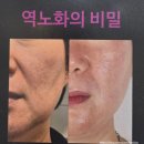 미엘뷰티 | 전주 피부 관리샵 마이크로젯 천방케어 서신동 미엘뷰티 관리 후기