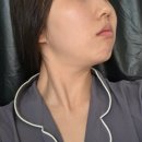 600 | 수원 윤곽관리 바로 예뻐지는 올타이트리프팅 600샷 효과 후기