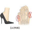소건막류 (Bunionette) 이미지