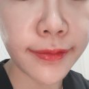 메디팜우정약국 | 분당여드름피부과 에토좀 아크네 관리로 제대로 효과봄