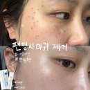 바로서면병원 | 부산(서면)-&#39;편평사마귀 co2레이저 시술후기&#39;(병원/시술3개월 후)내돈내산,재생크림추천