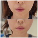 오토스킨위례지사 | 위례 팔자 주름관리 유행한다는 플라즈마 필러 고민하다가
