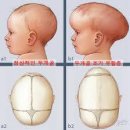 심각한 두상변형때문에 두상교정기를 끼는 아이들..jpg 이미지