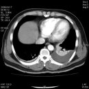 hemothorax/pleural effusion 환자의 조영전.후의 비교 영상 이미지