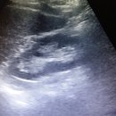 anechoic lesion at Rt. renal parenchyma 소견 부탁 드립니다. 이미지